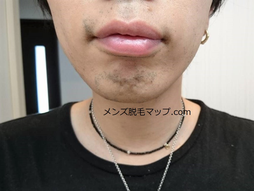 【ヒゲ脱毛】医療脱毛体験談！何回で綺麗になれるのか！？（６回目）