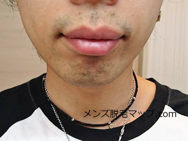 【ヒゲ脱毛】医療脱毛体験談！何回で綺麗になれるのか！？（７回目）
