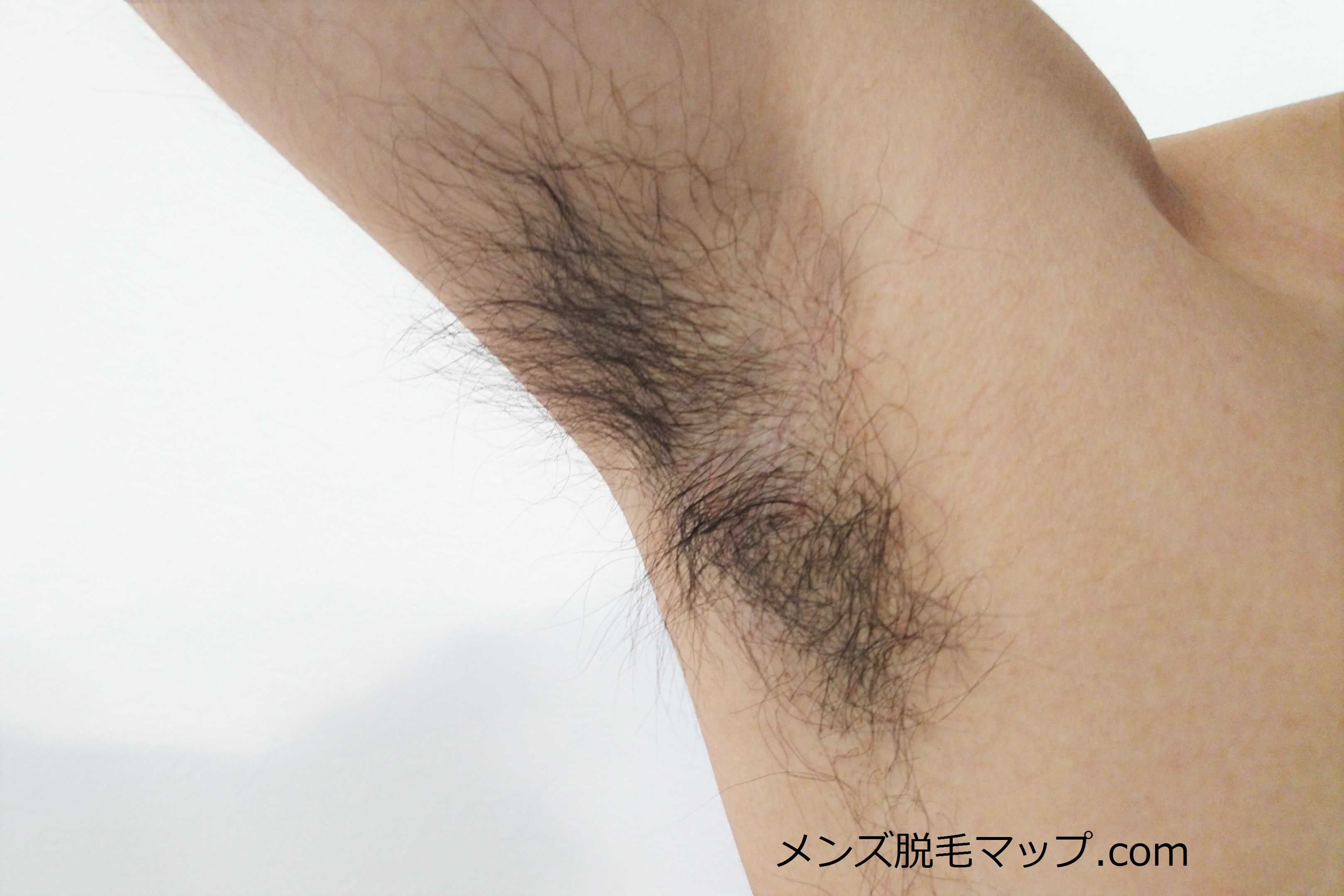 【脇毛脱毛】メンズの医療脱毛体験談！何回で綺麗になるか！？（１回目）