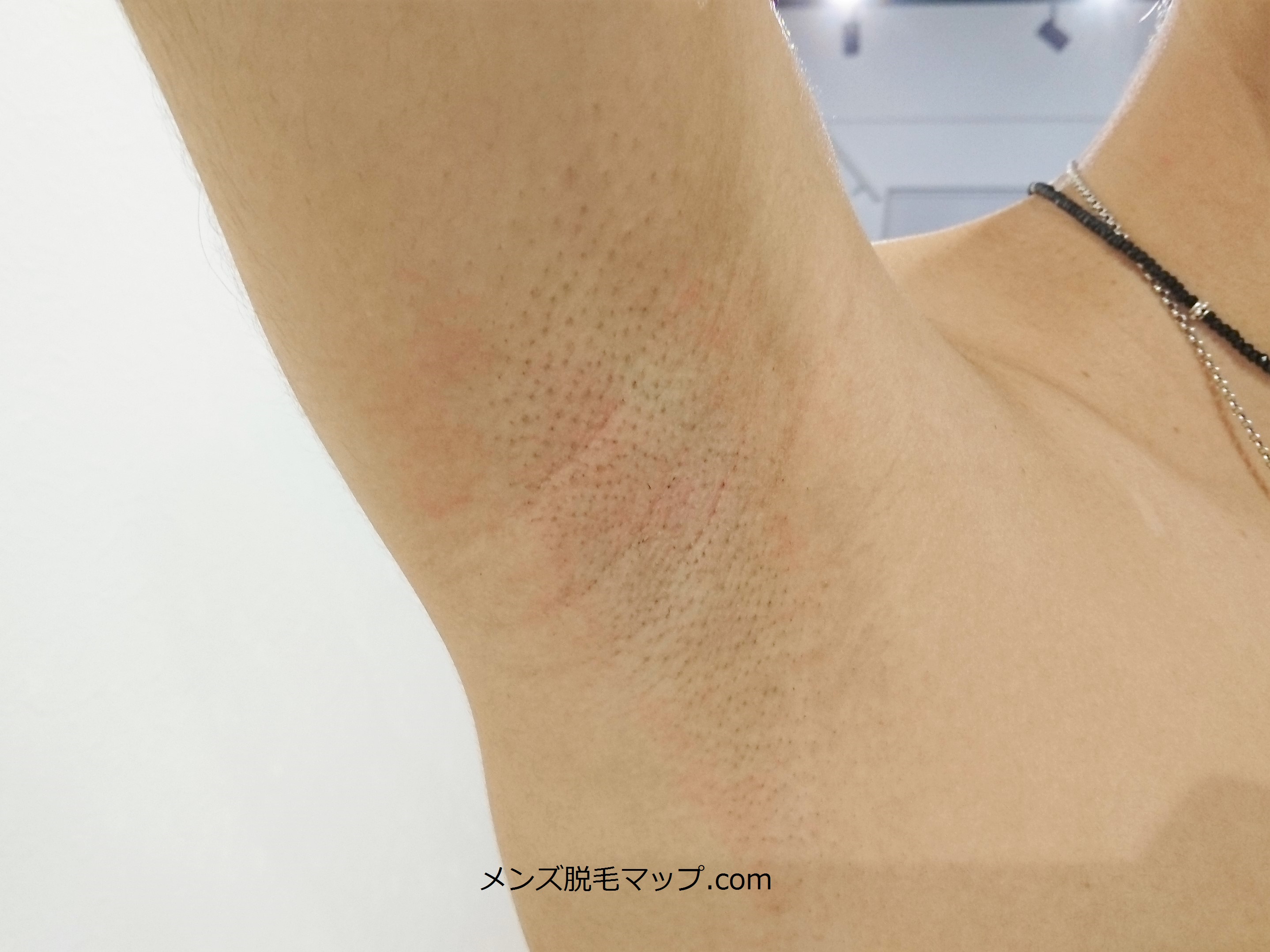 【脇毛脱毛】メンズの医療脱毛体験談！何回で綺麗になるか！？（２回目）